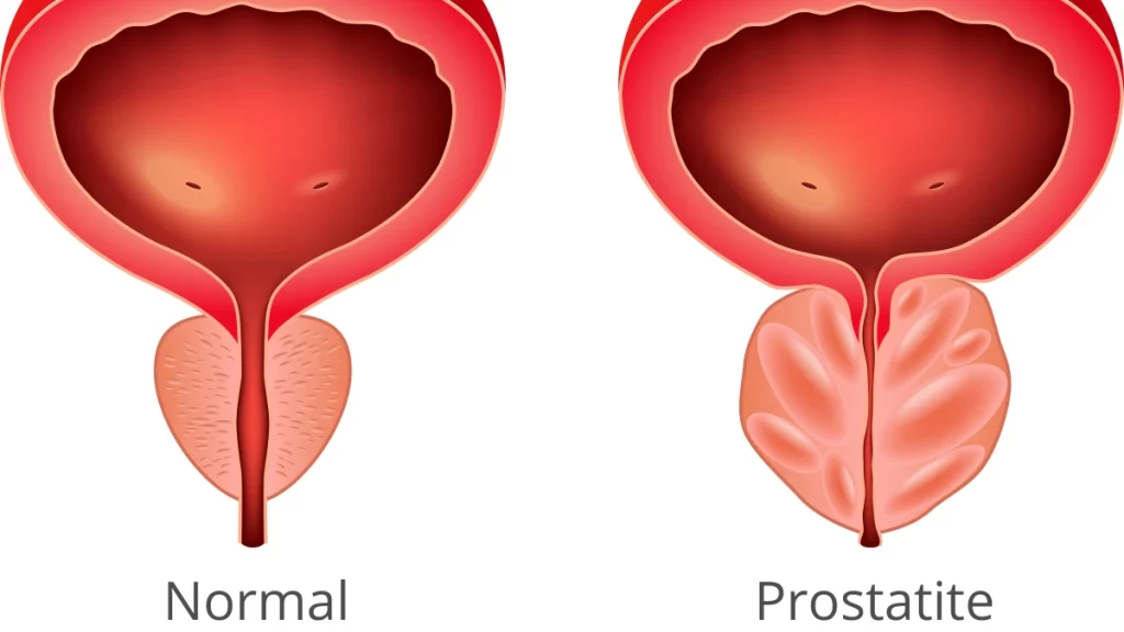 dr.consulta - Imagem com duas próstatas: do lado esquerdo a glândula normal; do direiro, com inflamação na próstata.
