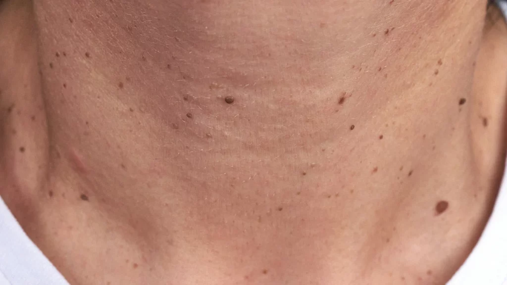 dr.consulta - Pescoço com verrugas.