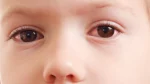 dr.consulta - Na imagem, olhos de criança com conjuntivite alérgica.