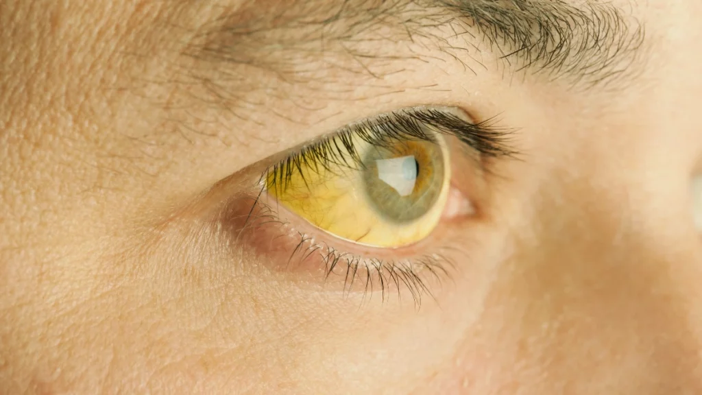 Descubra o que deixa pele e olhos amarelos