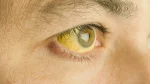 dr.consulta - Na imagem, pele e olhos amarelos de uma pessoa.