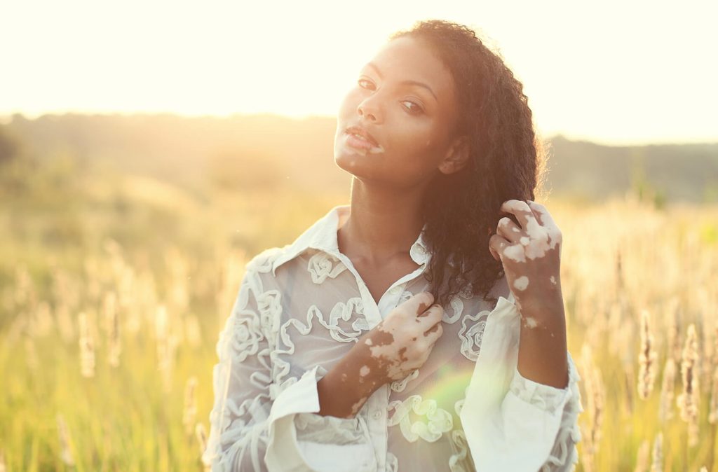 Vitiligo na pele: por que acontece e como evitar?