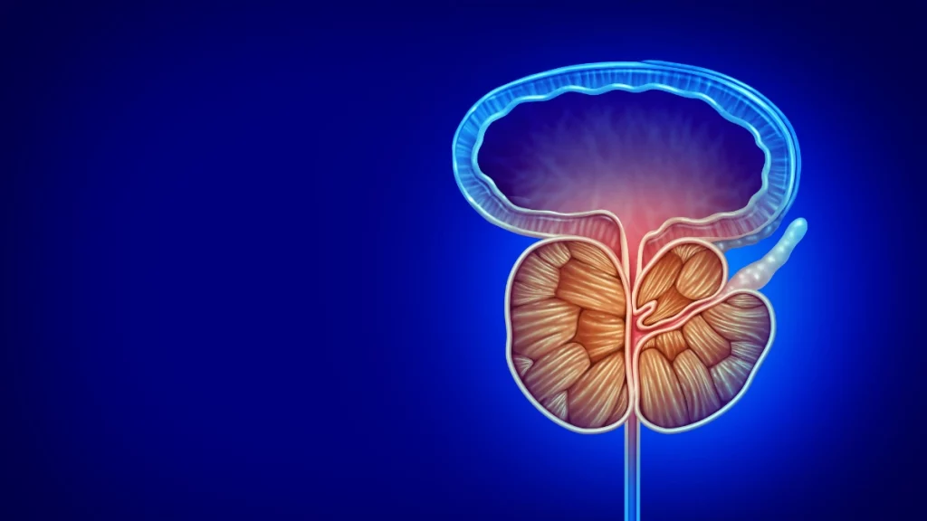 Hiperplasia da próstata é perigosa? Saiba mais