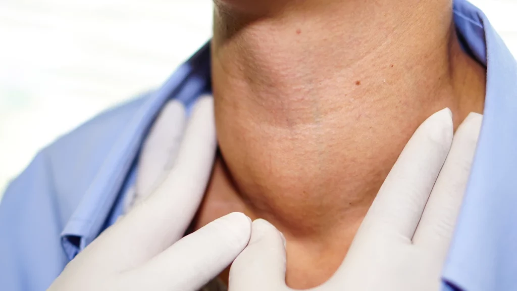 dr.consulta - Pescoço com bócio na tireoide.