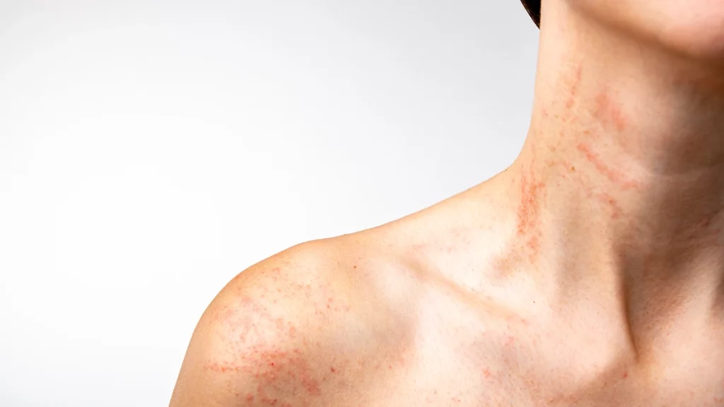 dr.consulta - Pescoço e ombro de uma pessoa com mancha vermelha na pele.