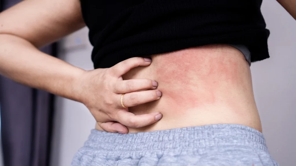 7 possíveis causas para a formação de mancha vermelha na pele