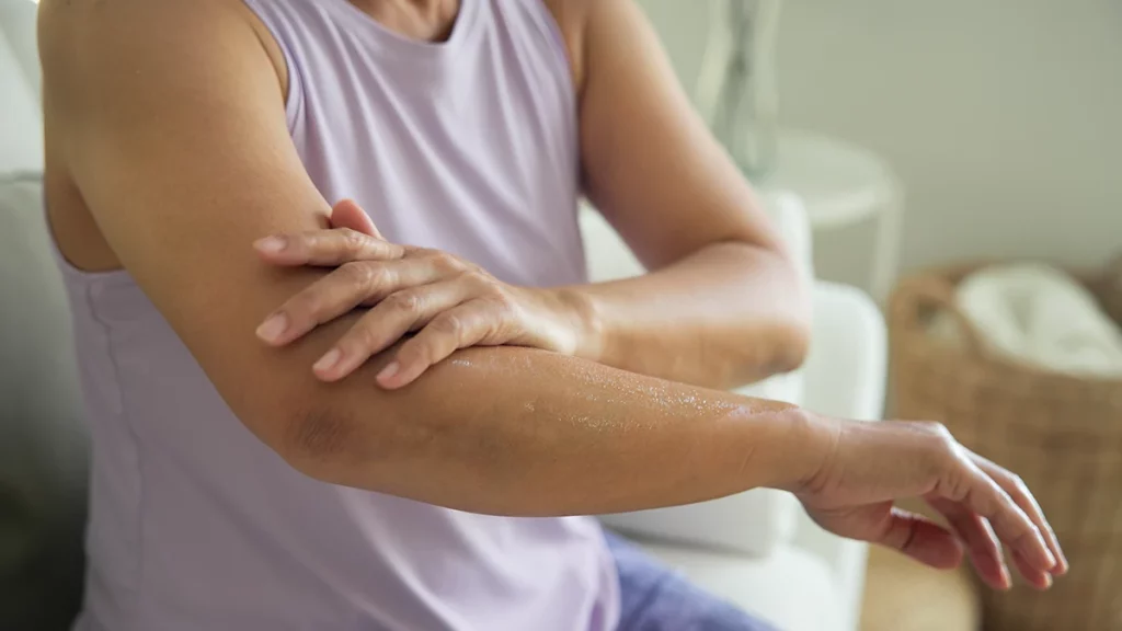 dr.consulta - Pessoa hidratando a pele para que ela não fique com aspecto de seca e áspera
