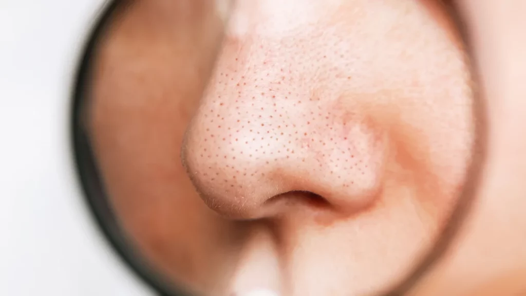 Cravos na pele são comuns, mas têm solução. Saiba como prevenir