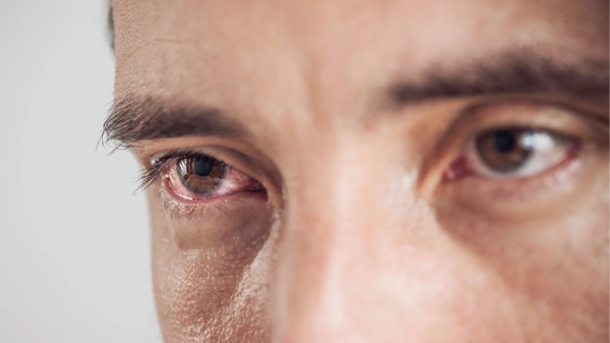 dr.consulta - Na imagem, olhos de homem com secreção representando um dos tipos de conjuntivite.