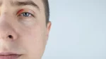 dr.consulta - Na imagem, homem com pálpebra vermelha causada por blefarite.