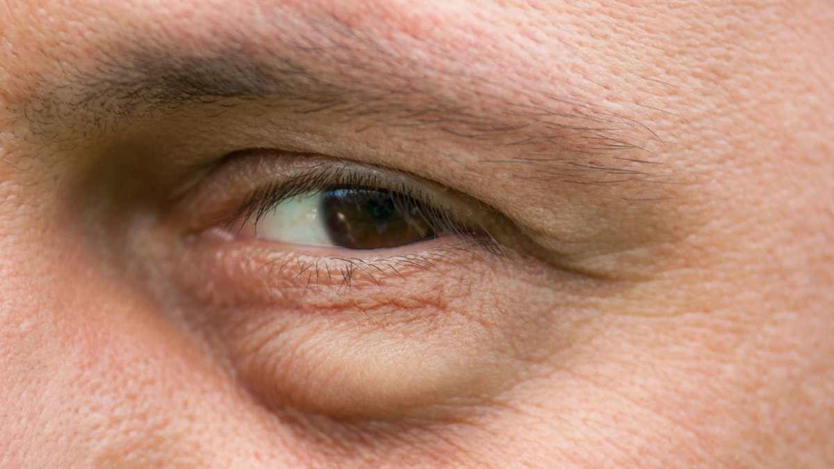 dr.consulta - Na imagem, olho inchado por celulite ocular.