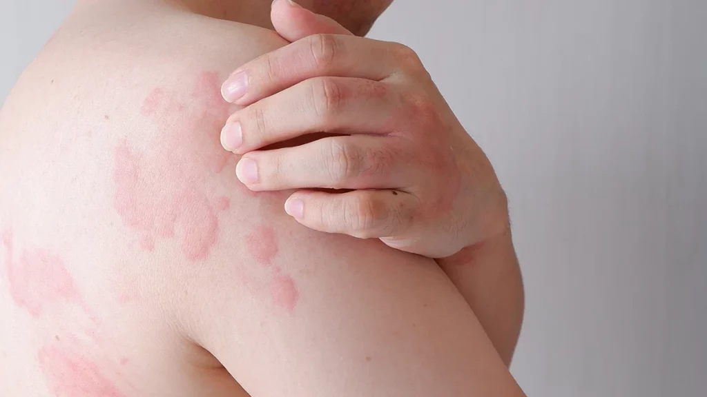 O impacto da urticária crônica espontânea sobre o bem-estar