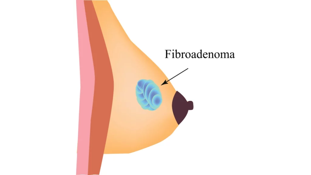 dr.consulta - Ilustração anatomica de fibroadenoma da mama em seio.