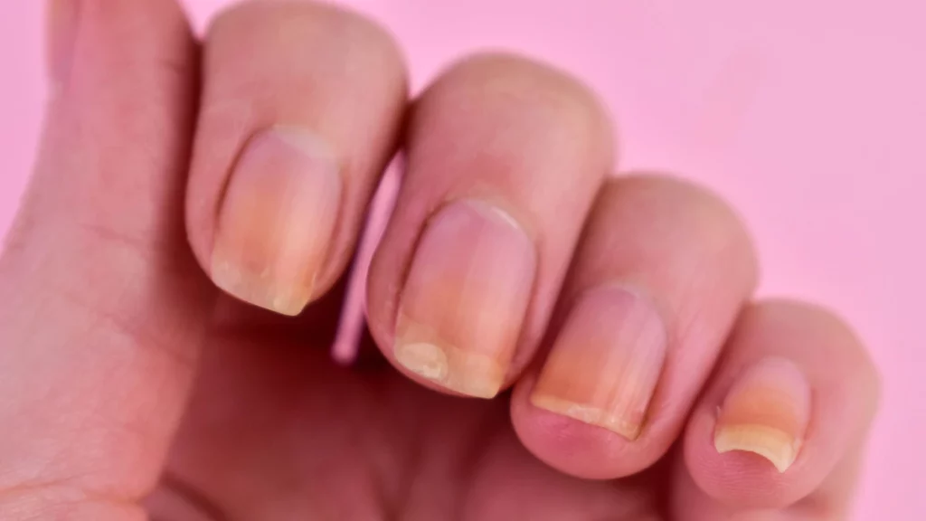 Falta de cuidados com as unhas reflete a saúde do corpo