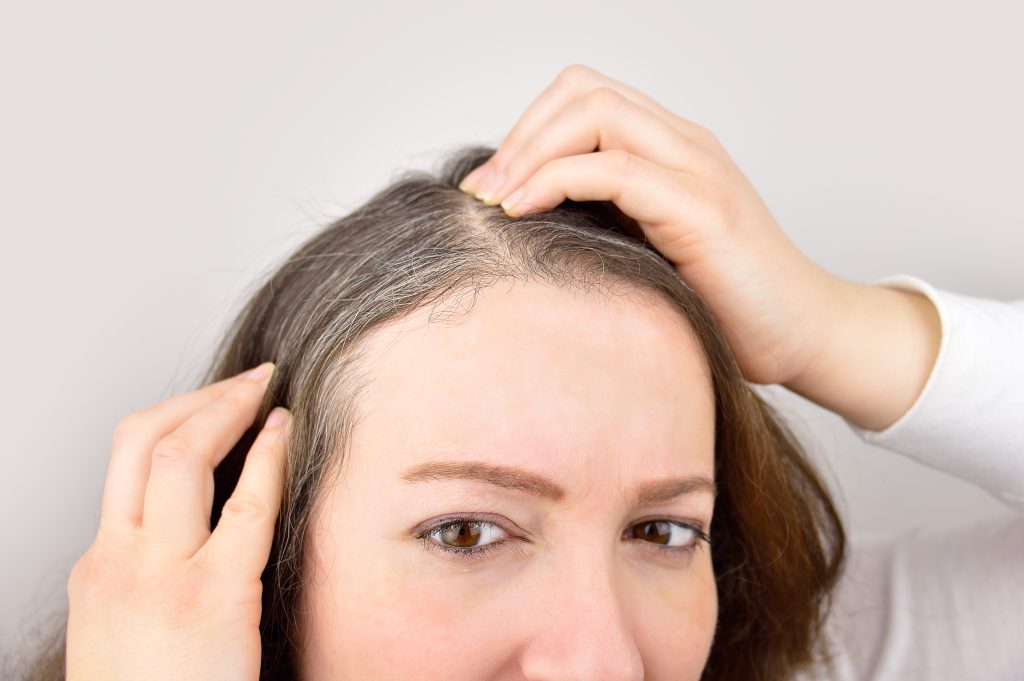 Cabelo branco em jovens é normal?