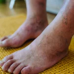 dr.consulta - pé diabético, sintomas diabetes, complicações diabetes