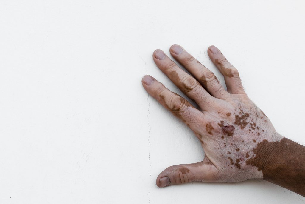 Vitiligo: o que é, causas, sintomas e tratamento