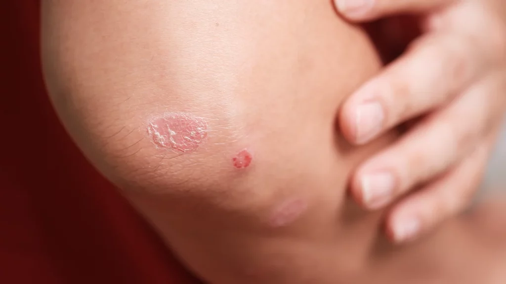 dr.consulta - Pessoa com placas avermelhadas cobertas por escamas esbranquiçadas no cotovelo, sinal de psoríase