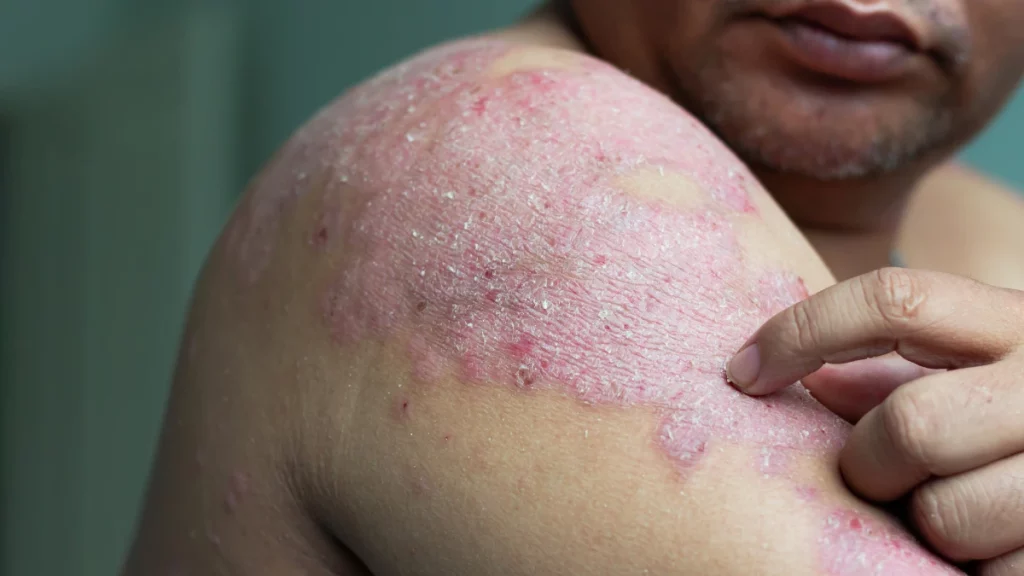 dr.consulta - Homem coçando placa de descamação da pele típica da psoríase.