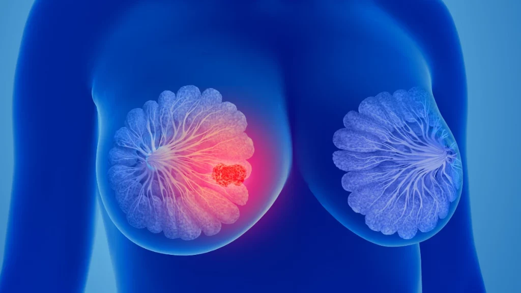 dr.consulta - Ilustração de par de seis. Um deles apresenta tumor maligno, quadro de câncer de mama.