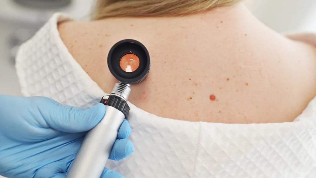 O que faz do câncer de pele melanoma raro, mas perigoso