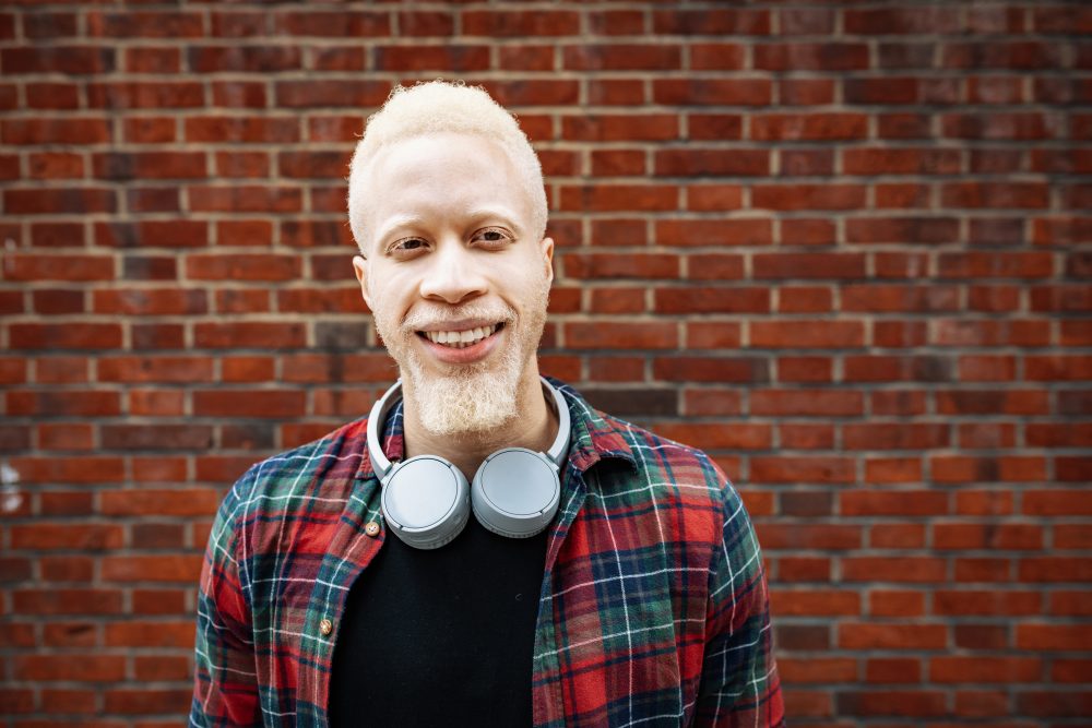 Albinismo: o que é, sintomas e cuidados necessários