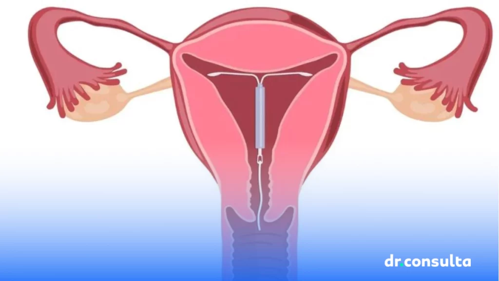 Como é feita a colocação de DIU? Veja os cuidados necessários