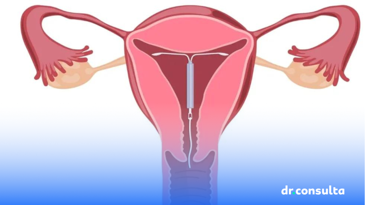 Como é feita a colocação de DIU? Veja os cuidados necessários | Blog dr ...