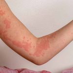 Braço com uma manifestação de alergia emocional