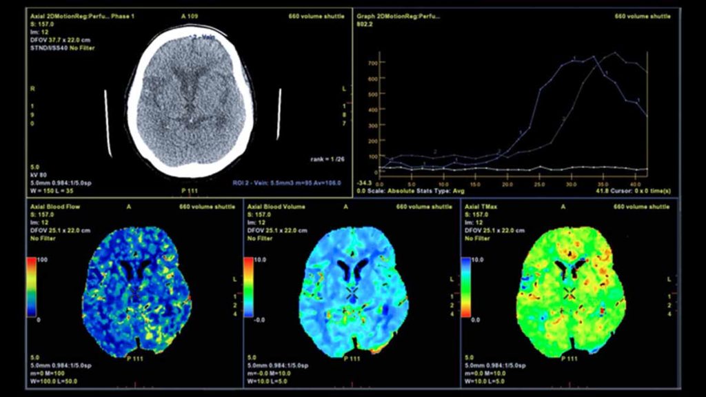 Exame para diagnóstico do aneurisma cerebral