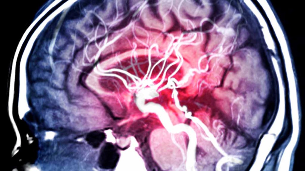 Diagnóstico de aneurisma cerebral.