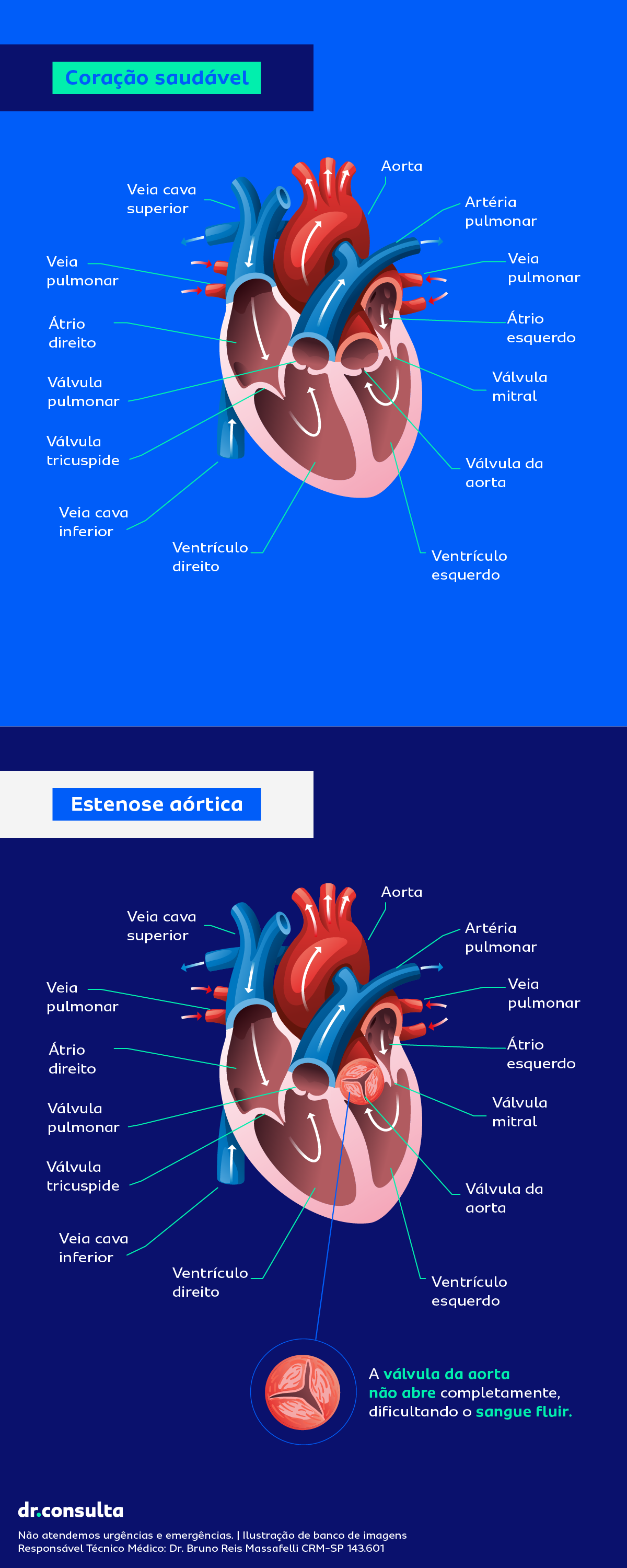 Ilustração representando a anatomia do coração e a estenose aórtica