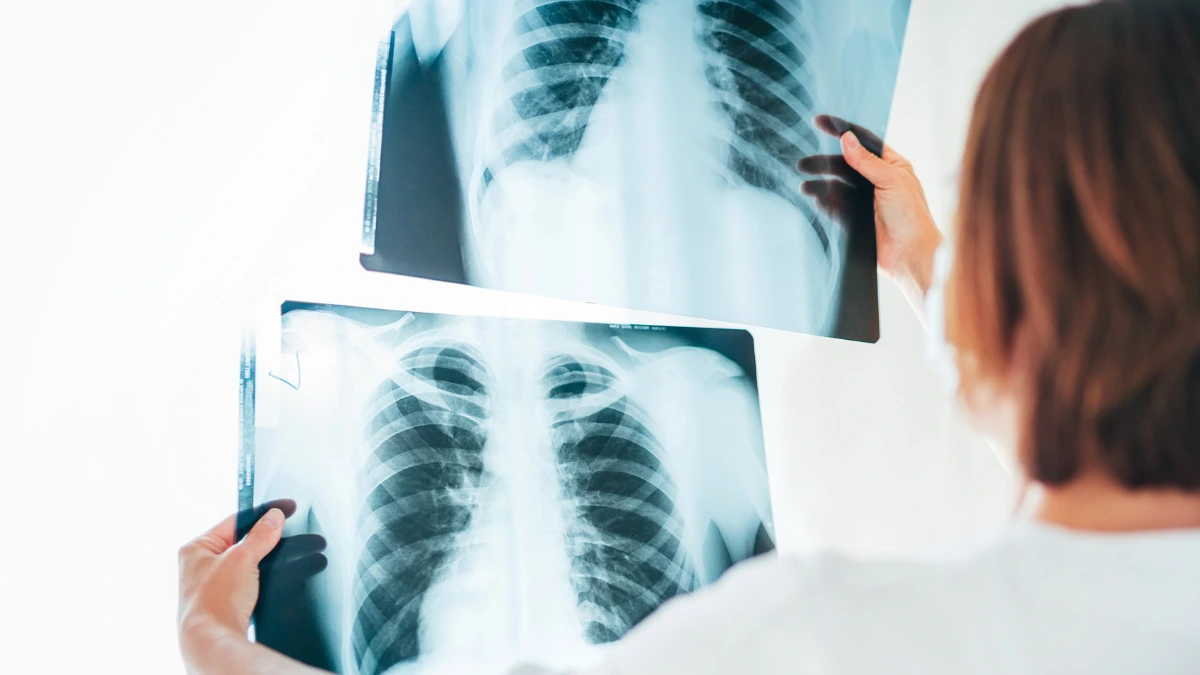 dr.consulta - infecção pulmonar