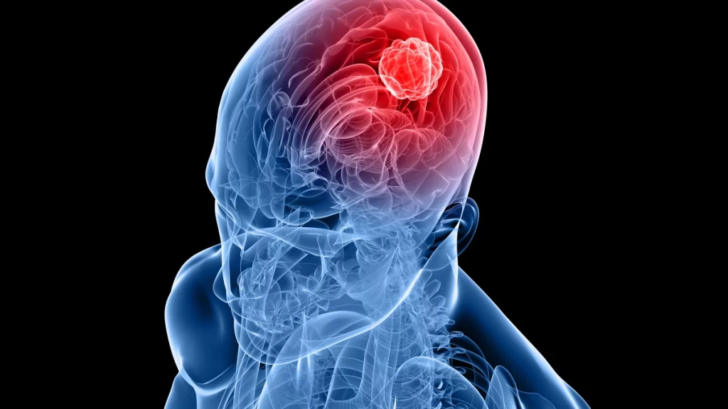 Saiba mais sobre as características de um câncer no cérebro