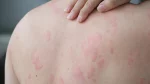 dr.consulta - Erupção cutânea avermelhada em formato de borboleta característica do lúpus