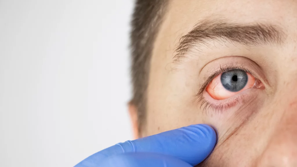 dr.consulta - homem com olhos inflamados sendo avaliado por um oftalmologista, secreção nos olhos, remela, cuidados com a saúde ocular