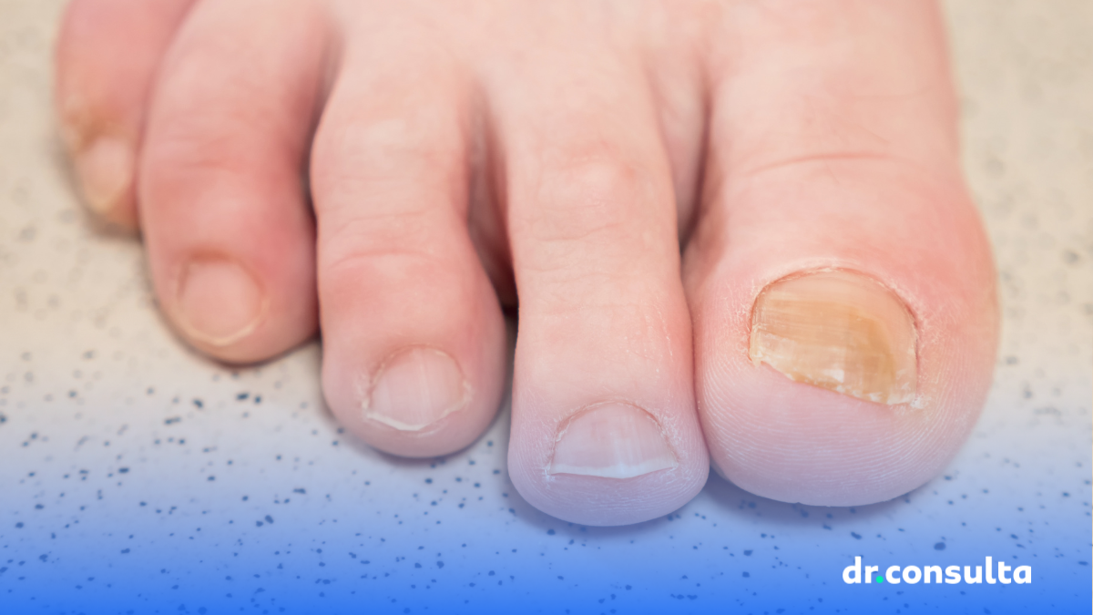 Estou ficando com as unhas amarelas. O que fazer? | Blog dr.consulta