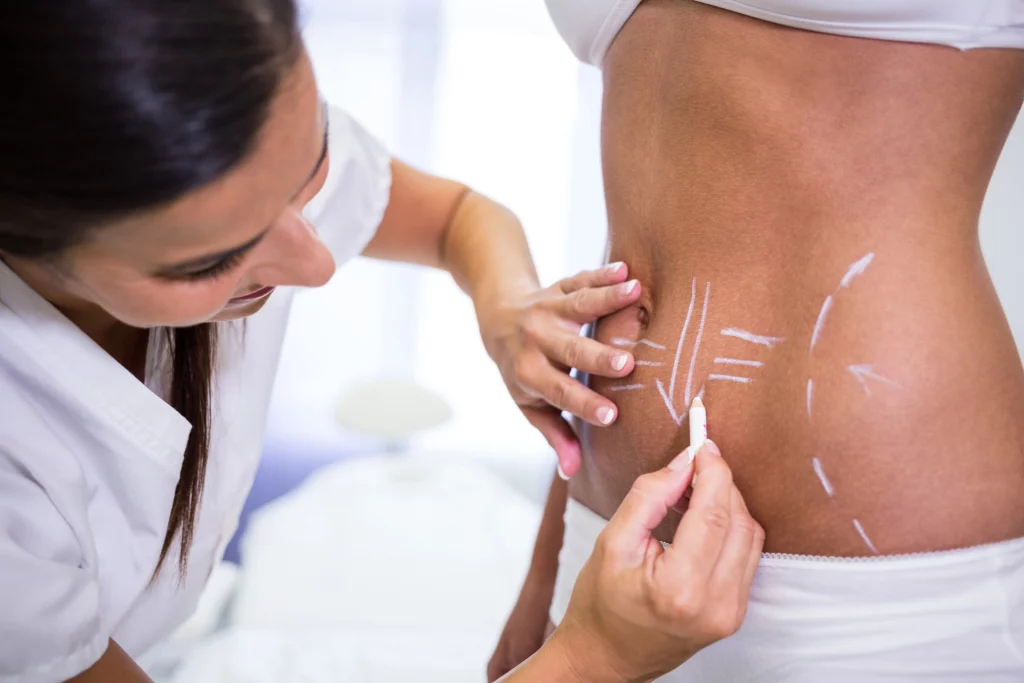 Imagem de uma médica realizando marcações que irão guiar o procedimento de lipoaspiração. 