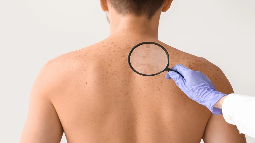 Imagem das costas de uma pessoa adulta examinada por um profissional de dermatologia com uma lupa.