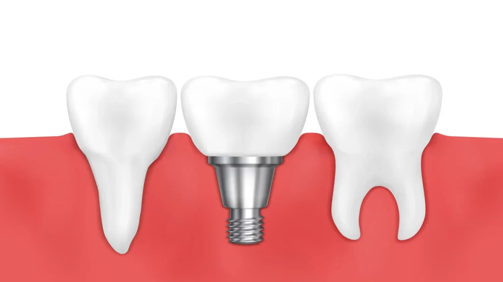 Imagem ilustrativa de três dentes, sendo um deles uma prótese dentária.