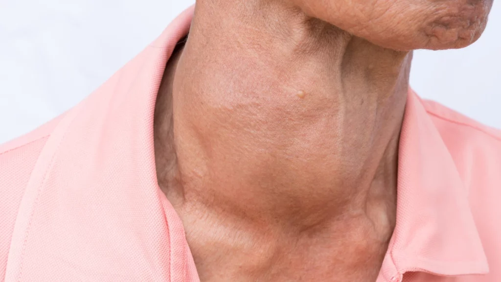 dr.consulta - Na imagem, pescoço com bócio. A doença é diagnosticada em exames para tireoide.