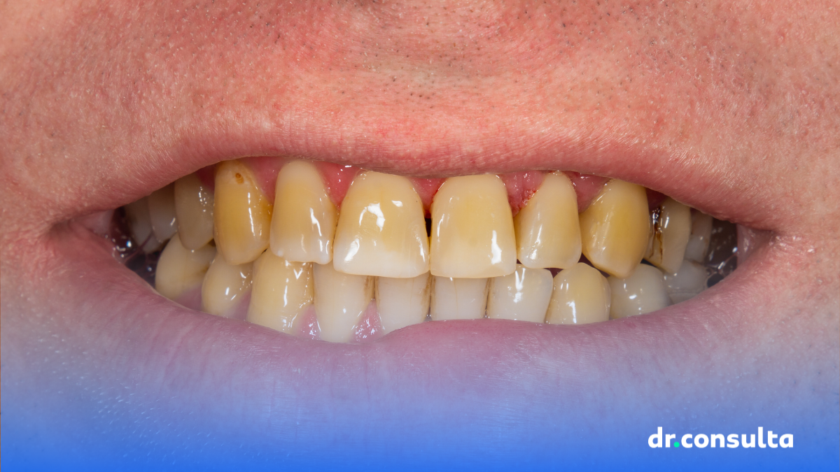 dr.consulta - sorriso com dentes amarelados, dentes amarelos, como evitar dentes amarelados,