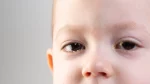 dr.consulta - Na imagem, bebê com secreção no olho.