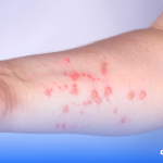 dr.consulta - mpox, infecção, pele afetada, prevenção