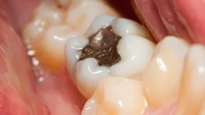 Saiba como funciona a obturação de um dente