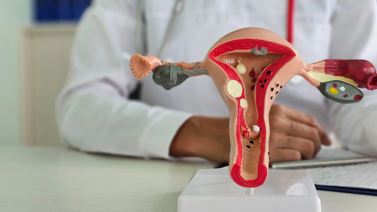 dr.consulta - Miniatura de sistema reprodutivo feminino, com cisto no útero.
