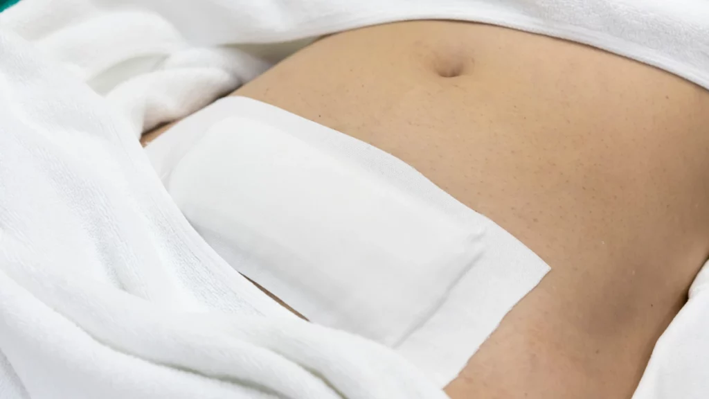 dr.consutla - mulher pós cirurgia de histetectomia