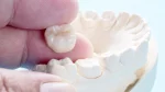 dr.consulta - Imagem de coroas dentárias sendo moldada com arcada de gesso do paciente.