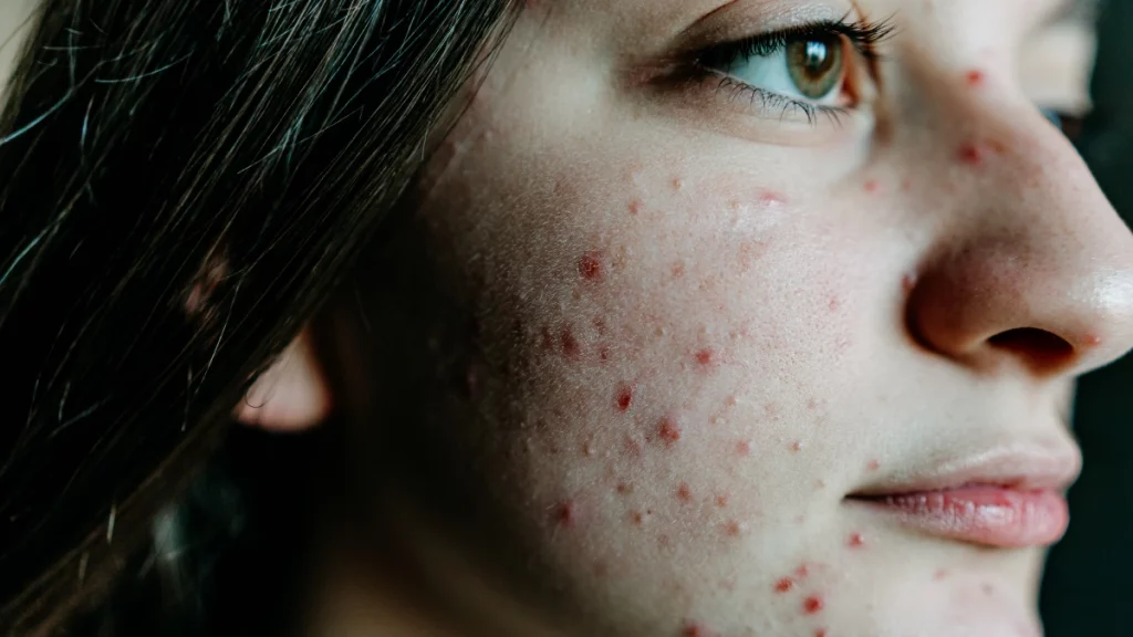 Entenda como desequilíbrio hormonal afeta as mulheres
