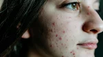 dr.consulta - jovem com pele cheia de acne, desequilíbrio hormonal